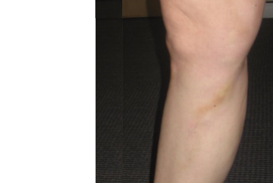 spider veins after