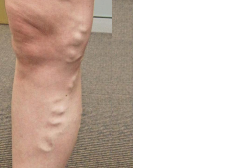 spider veins before